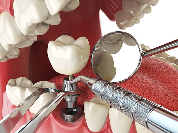 Best Emergency Tooth Extraction in Warsaw, IL
